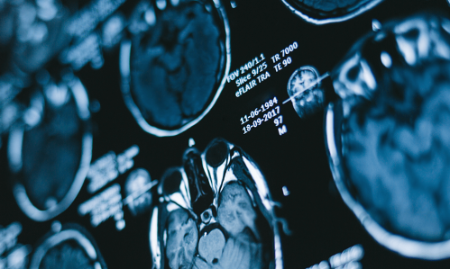 A Way of Predicting if New Psychosis Patients Will or Won’t Respond to Standard Treatment